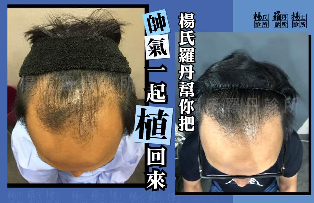 【植髮】楊氏羅丹幫你把帥氣一起『植』回來